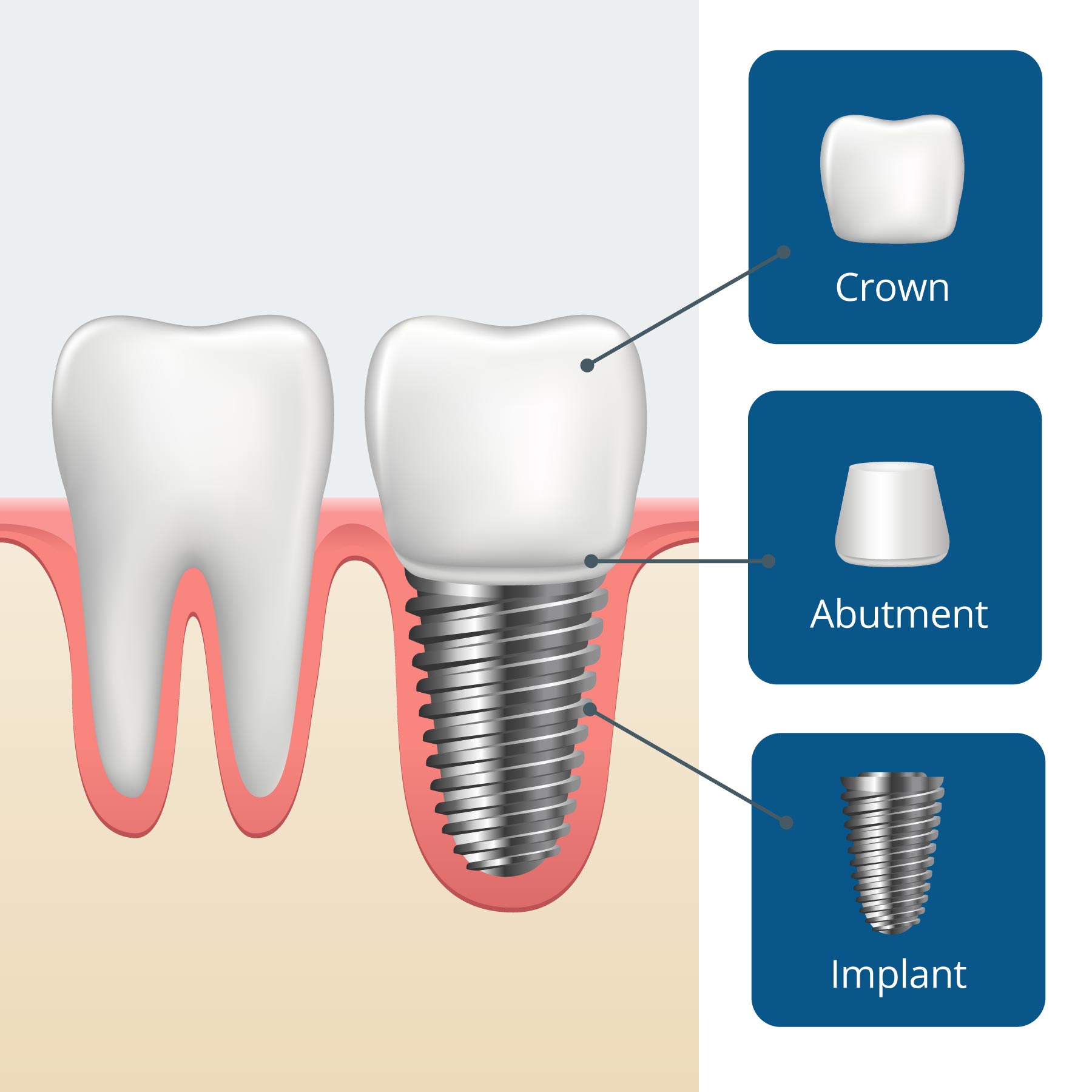 What Are Full Mouth Dental Implants Eon Clinics