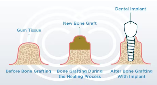 Demystifying Bone Grafting in Dental Implants